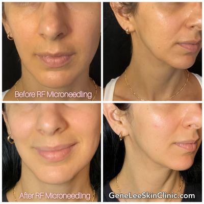 RF Microneedling