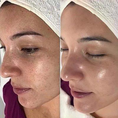 Chemical peel