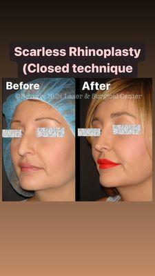 Close Rhinoplasty Technique