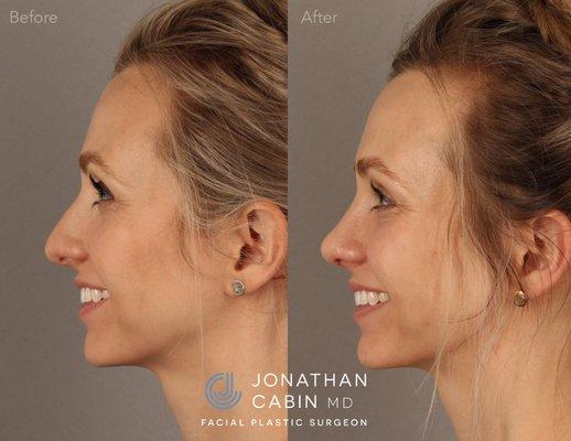 Primary Rhinoplasty (Nose Job)