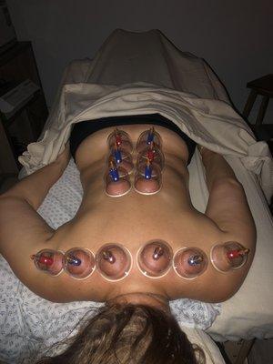 Cupping Therapy