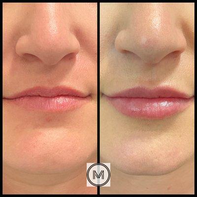 Before and after Restylane Kysse to lips