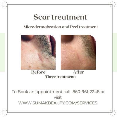 Microdermabrasion & Peel treatment