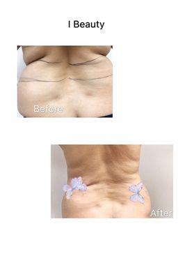 liposuction