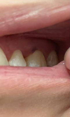 Swollen gum from aggressive cleaning.