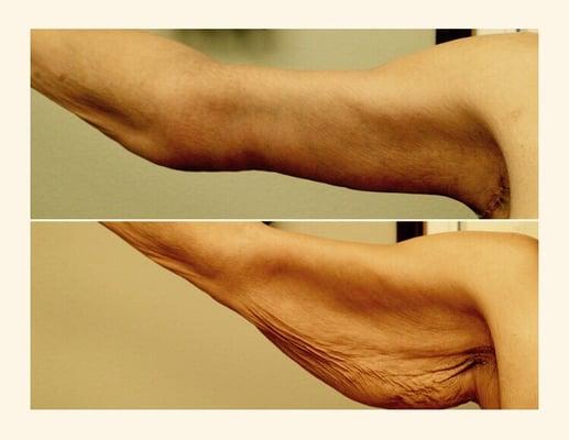 Before and after arm lift.