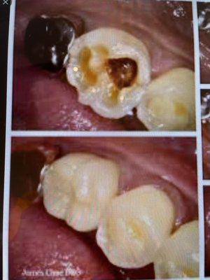 My tooth before and after