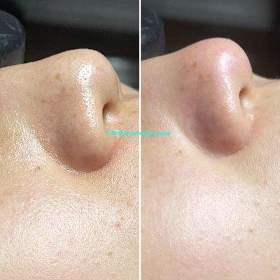 Before/After Deep Cleansing Facial