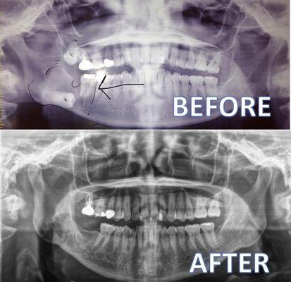 Jaw Cyst removed successfully