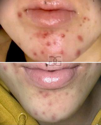 Acne Treatment Results