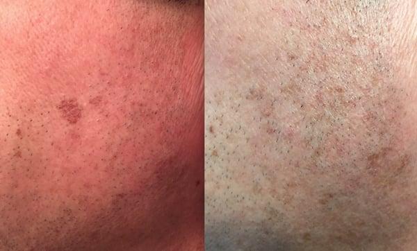 Before and after photos of my laser treatment on side of my face.