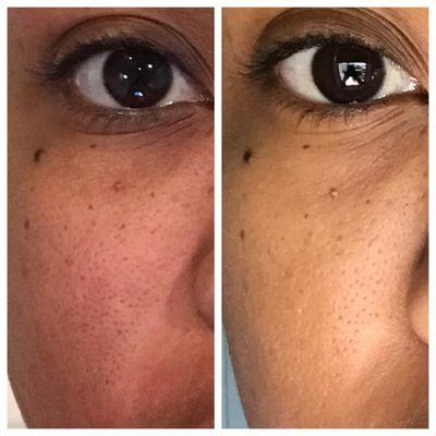 Before (left) and after (right) a single microdermabrasion treatment. Notice the fine lines aren't as deep and the pores aren't as large.