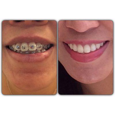 Before and after! I love how quickly my teeth were straightened!