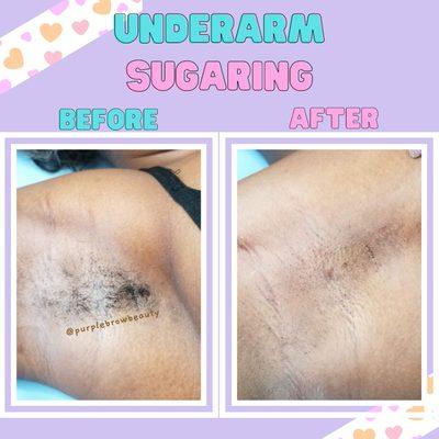 Underarm Sugaring