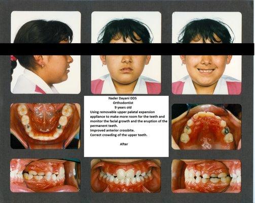 Phase I cross bite AFTER