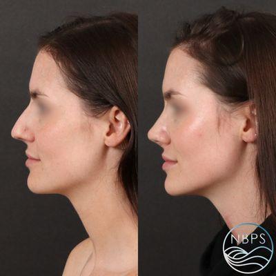 Rhinoplasty by Dr. Sailon