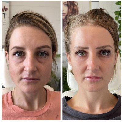 Tear troughs, cheeks, lips, facial slimming with dysport, upper face dysport