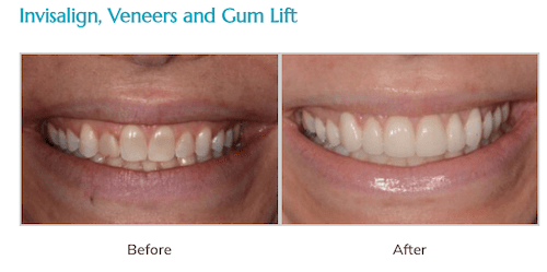 Before and after invisalign, veneers and gum lift