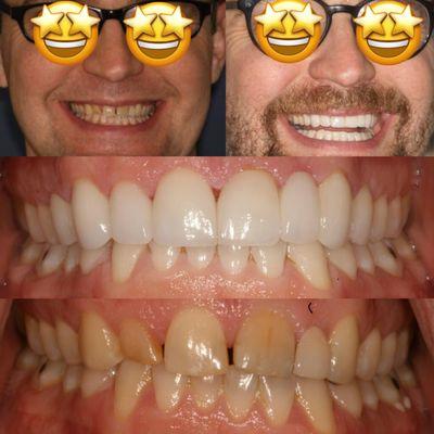 Invisalign , whitening , restorative bridge and veneers made this patient smile from ear to ear !