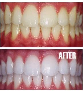 Zoom Whitening