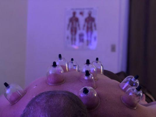 Cupping therapy