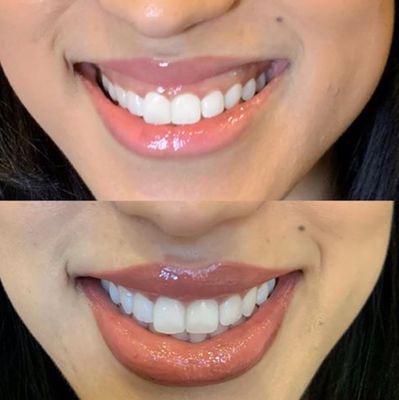 12 units of Dysport and 1.5ml of Restylane corrected this "gummy smile".