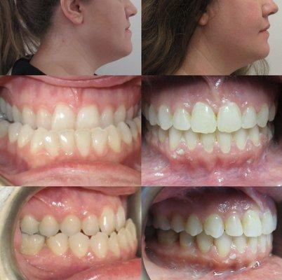 Severe underbite treated surgically for facial improvement