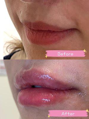 Juvederm lip filler