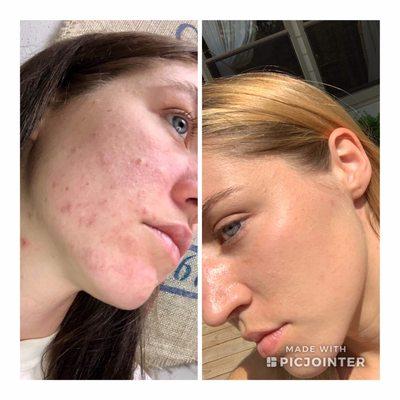 Before and after Photos taken by client, 8 months apart. Check out that transformation! Peels, Hydrafacials and healthy gut!