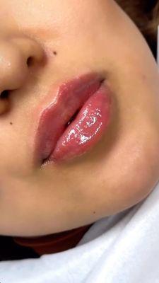 After lip filler treatment