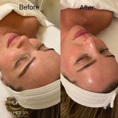 Idan Med Spa Triple layer facial before and after