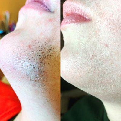 Before + After laser hair removal