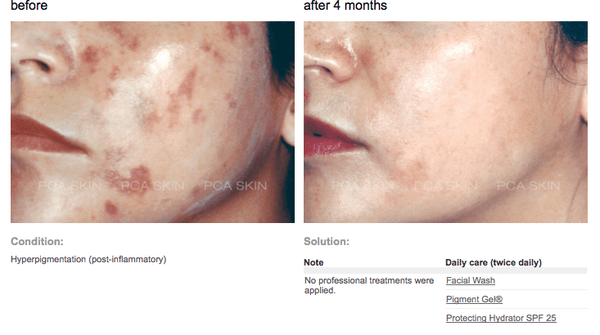 Post Inflammatory Hyperpigmentation. Home care regimen after only four months.