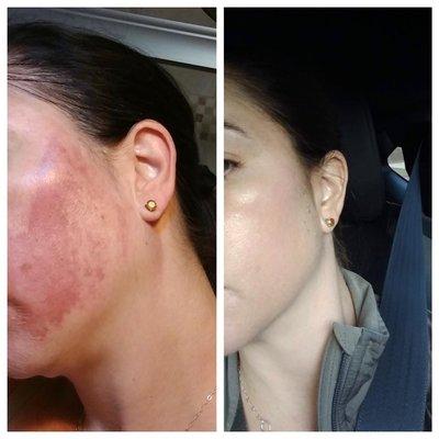 Before/After chemical peel for hyperpigmentation