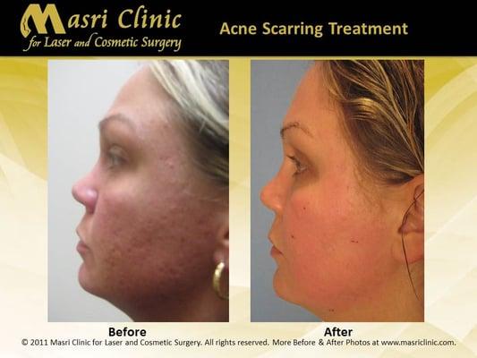 After acne treatment and CO2 Laser Skin Rejuvenation treatment, drastic improvement in deep acne scars, pitting & active acne.