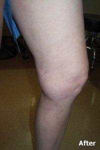 Patient 2 - varicose vein treatment AFTER