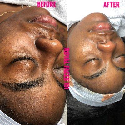 AHA facial