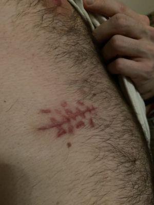 Scar 1 month after operation. You can see clear additional scarring from the thick stitches