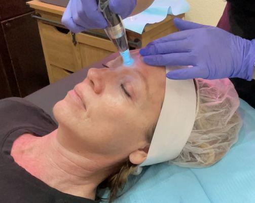 Microneedling