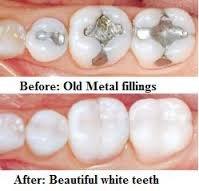 Come in and get your old fillings updated!