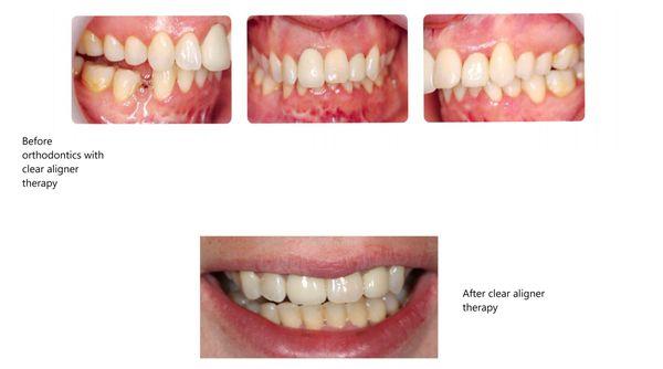 Results of clear aligner therapy.  AKA invisilign/clear correct.