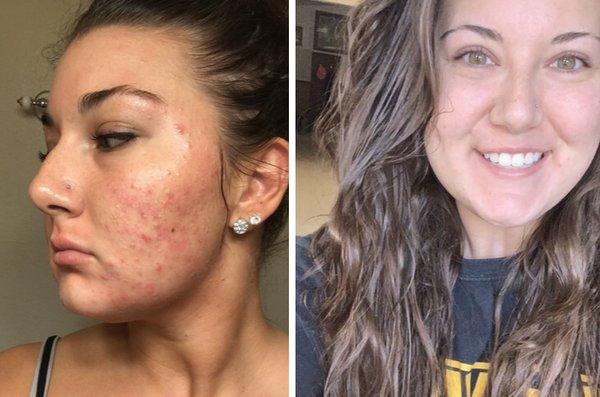 Before and after our all natural, non-invasive acne protocol. Even the most sensitive skin will see results.