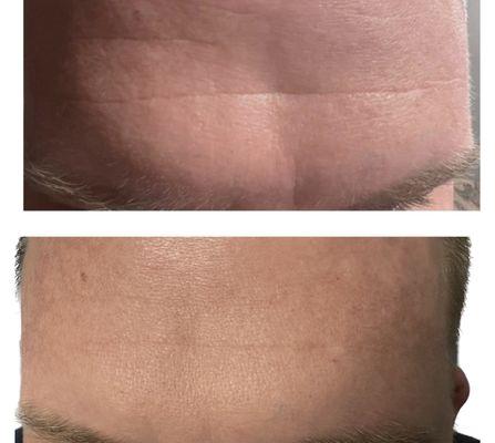 Before/After - Learn more about our botox services today!