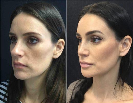 Before and After Rhinoplasty & Facial Rejuvenation