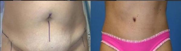 Tummy Tuck Before & After