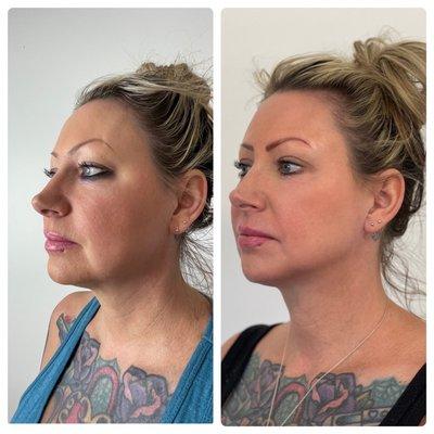 Before & After from one face sculpting procedure