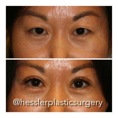 This woman was bothered by the asymmetry in her eyelid folds and heaviness of her eyelid. She had a upper eyelid blepharoplasty with crease