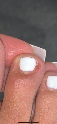 My Infected toe nail