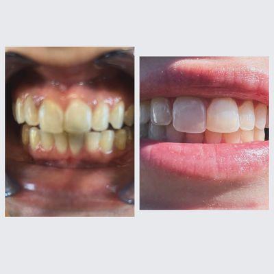 Before and after she tried my teeth whitening treatment! She loved