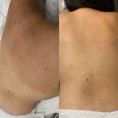 Bacne treatment before and after (2 months progress)